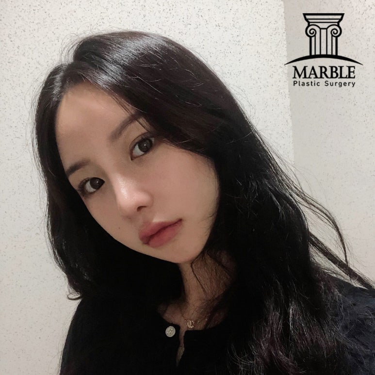 강남역성형외과, 쌍꺼풀후기 첫 눈에 반하는 눈! 관련 이미지 2