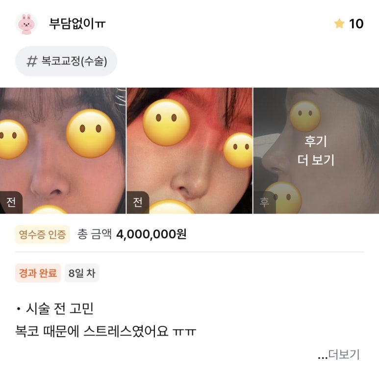 [Bulbous Nose Surgery Review] Solved My Plain Bulbous Nose Concerns! I Got a More Defined Nasal Bridge and a Better Impression! image 1
