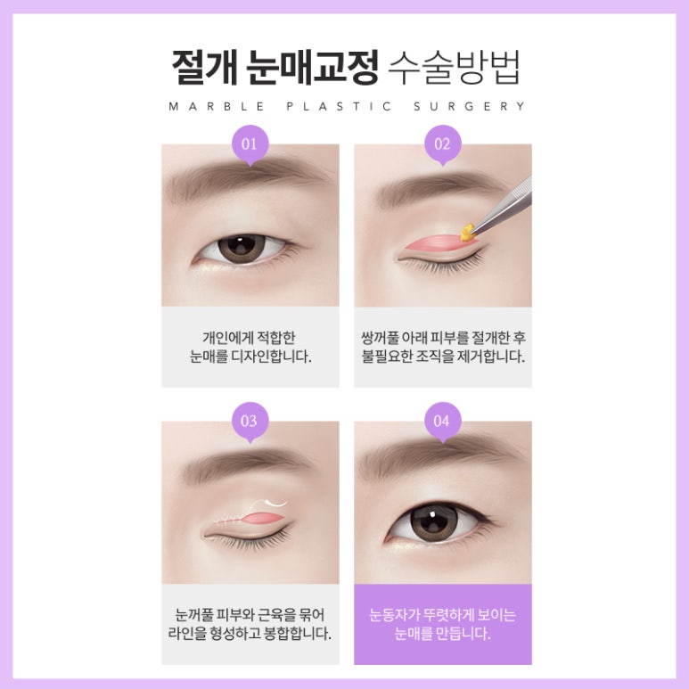 안검하수 처진눈 교정으로 또렷한 눈매를! 관련 이미지 8