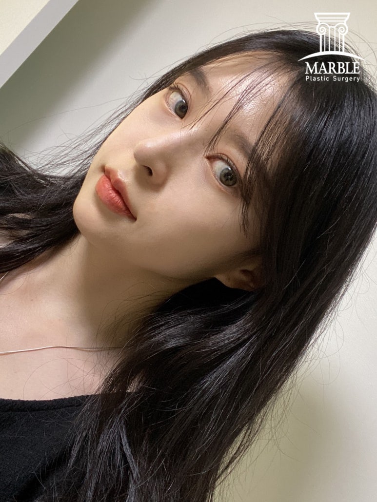 더 이상 쌍꺼풀재수술은 그만, 내 눈은 왜 잘 풀릴까? 관련 이미지 5