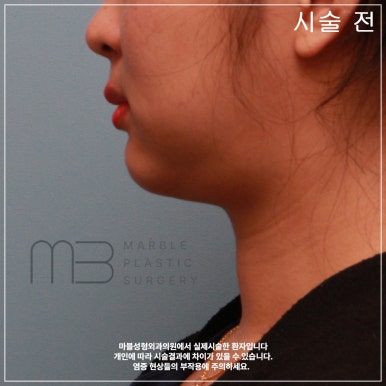 마블성형외과의 V업주사 (브이업주사), 왜 특별할까? (전후사진O) 관련 이미지 6