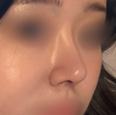 [Gangnam Plastic Surgery Bulbous Nose Surgery Review] I Was Stressed About My Nose Filler Spreading... but the Natural-Looking Straight-Line Profile Was a Huge Success! Haha image 7