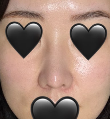 [Gangnam Plastic Surgery Rhinoplasty Review] I Was Worried About My Bulbous Nose.. It Turned Out Beautiful While Healing Well Without Inflammation or Side Effects hehe image 7