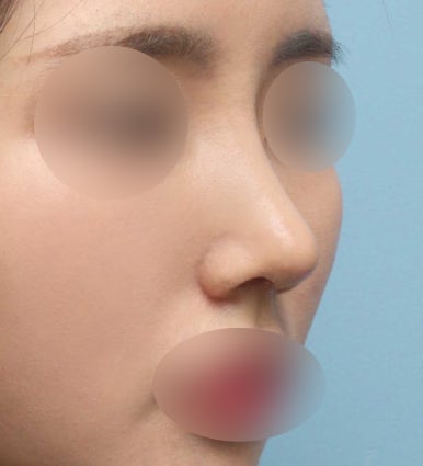 보형물 없이 하는 코수술, 무보형물 코수술이 가능한 경우는? 관련 이미지 4