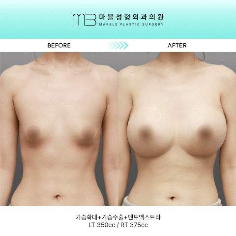 [멘토 가슴성형] 가슴확대수술 4개월 차: 멘토엑스트라로 완성한 이상적인 황금 비율의 정석 관련 이미지 1