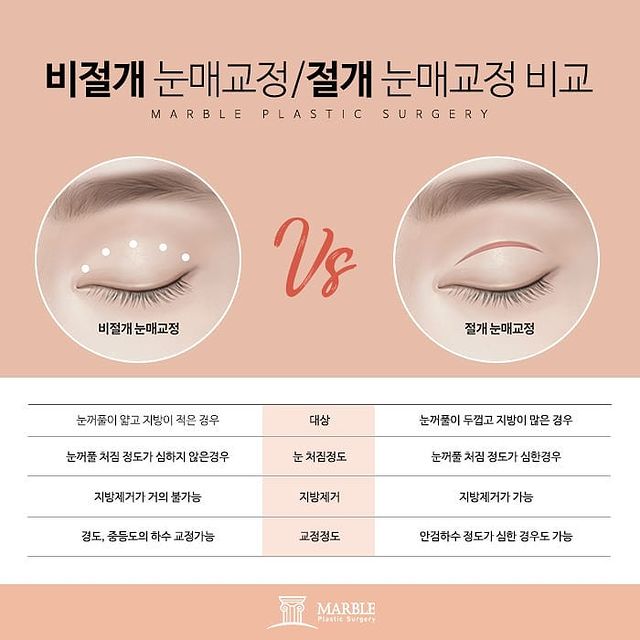 비절개눈매교정 개인 차이에 따라 마블성형외과의원 관련 이미지 4