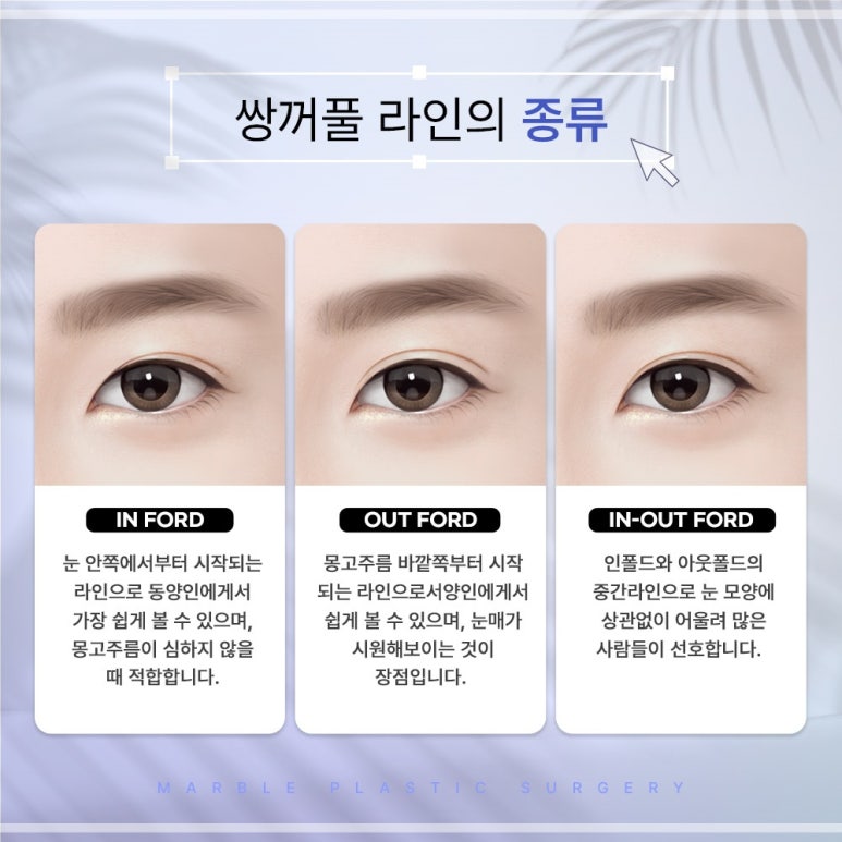 자연유착쌍꺼풀후기 눈매를 더욱 또렷하게 관련 이미지 10