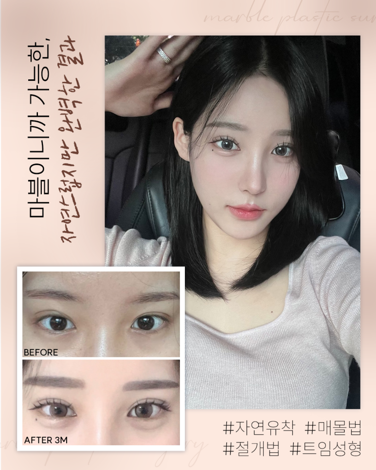 강남역 쌍수 잘하는 병원 잘 찾아보는 방법 관련 이미지 1