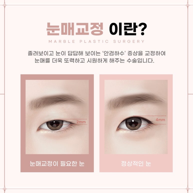 눈성형잘하는곳의 수술과 눈매교정에 대하여 관련 이미지 2