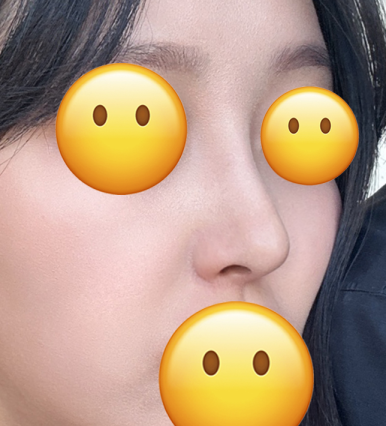 [Bulbous Nose Surgery Review] Solved My Plain Bulbous Nose Concerns! I Got a More Defined Nasal Bridge and a Better Impression! image 7