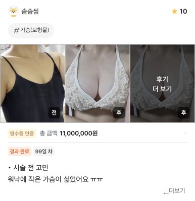 [강남성형외과 가슴수술 후기] 고민한 시간이 아까울 정도.. 서일범 원장님 만나고 워너비 라인 성공ㅎㅎ 관련 이미지 1
