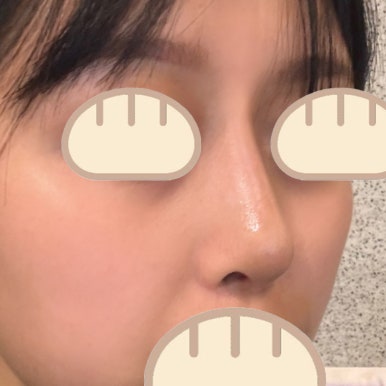 [강남성형외과 복코성형 후기] 보정하기 바빴던 펑퍼짐한 복코.. 얼굴 밸런스에 맞게 바꿔주셨어요! 관련 이미지 7