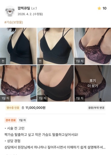 [Gangnam Station Plastic Surgery Breast Surgery Real Review] Worrying only delays time.. I corrected my uneven breasts and finally became glamorous! image 1