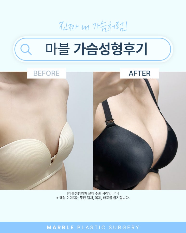 가슴 보형물 선택 기준은? 관련 이미지 3