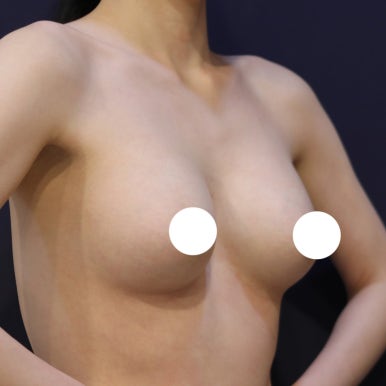 [Gangnam Plastic Surgery Breast Surgery Review] I Didn’t Like the Shape or Feel of My Breasts... My Revision Surgery with Mentor Extra Was a Success, Haha image 5