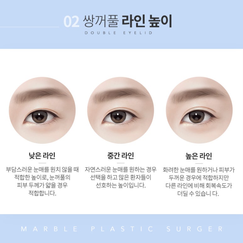 강남쌍꺼풀수술 체크해야 할 사항은? 관련 이미지 6