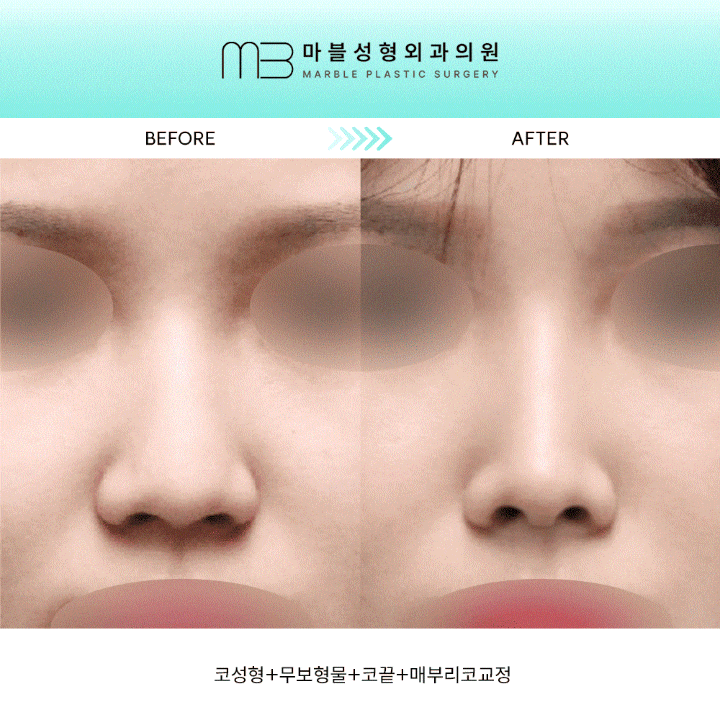 [First Rhinoplasty] Month 2 of Hump Nose Correction: The Standard for Implant-Free Hump Nose Correction image 1