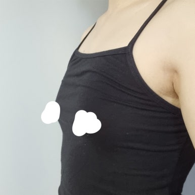 [강남역 성형외과 가슴수술 후기] 나만 알던 짝가슴 스트레스ㅠㅠ 서일범 원장님 만나고 완벽 대칭 성공ㅎㅎ 관련 이미지 3