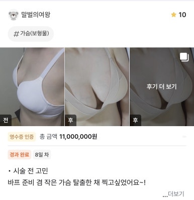 [Gangnam Plastic Surgery Breast Augmentation Review] I Escaped Uneven Breasts Before My Bikini Photoshoot! Thanks to Dr. Seo Il-beom, the Breast Master, It Was a Successㅎㅎ image 1