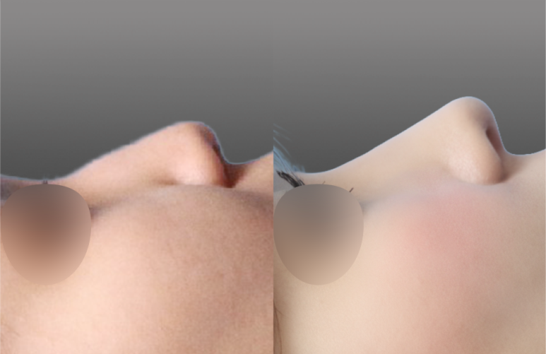 [First Rhinoplasty] Month 2 of Hump Nose Correction: The Standard for Implant-Free Hump Nose Correction image 4