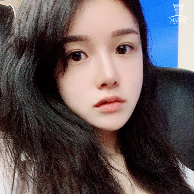 눈재수술비용 알아보고 있다면 관련 이미지 5