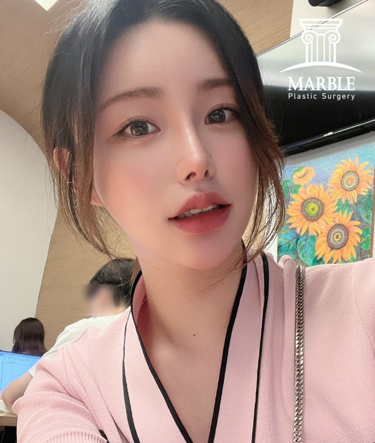 눈재수술 더 신중하게 고민해서 관련 이미지 2