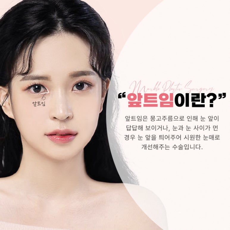 앞트임복원 왜 필요하고 어떻게 진행될까요? 관련 이미지 1
