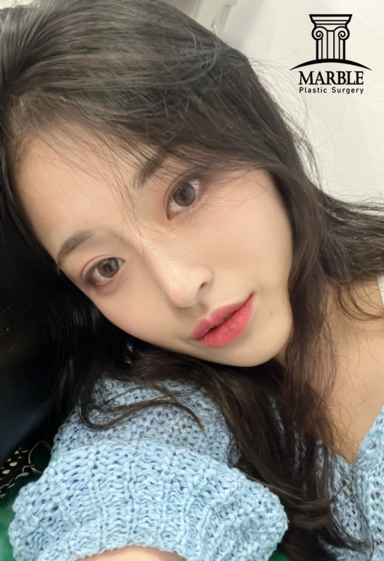 눈재수술 안정적이고 확실하게! 관련 이미지 1