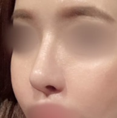 [강남역성형외과 매부리코성형 후기] 첫 수술 실패한 복코 매부리코.. 재수술로 완벽하게 성공했어요! 관련 이미지 5
