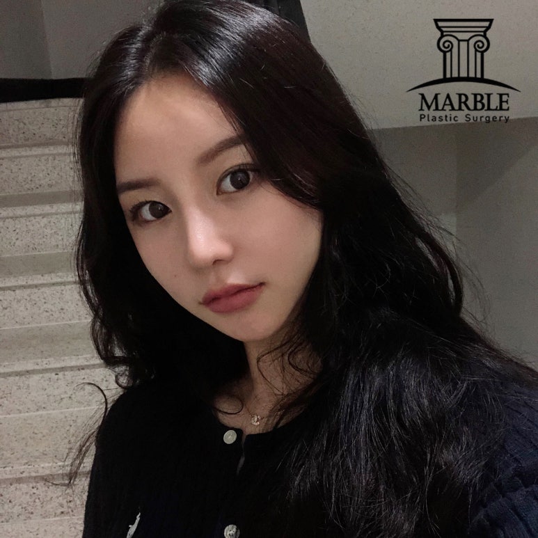 강남역성형외과, 쌍꺼풀후기 첫 눈에 반하는 눈! 관련 이미지 1