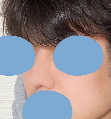 [Gangnam Plastic Surgery Male Nose Surgery Review] After tidying up the hump and bulbous nose that made me look stuffy, my T-zone and facial features looked completely alive! image 7