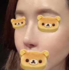 [강남역성형외과 매부리코수술 후기] 코재수술이라 진짜 무서웠는데 매부리코, 복코교정 한번에 해결 됐어요! 관련 이미지 7