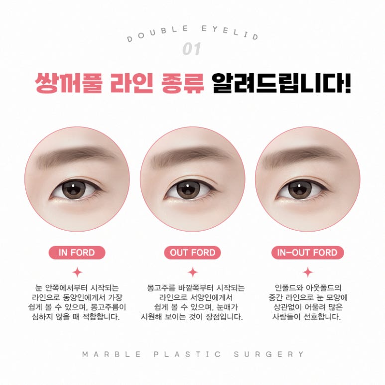 쌍꺼풀수술 고민될 때 반드시 확인해야할 것 관련 이미지 2