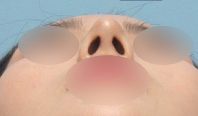 보형물 없이 하는 코수술, 무보형물 코수술이 가능한 경우는? 관련 이미지 8