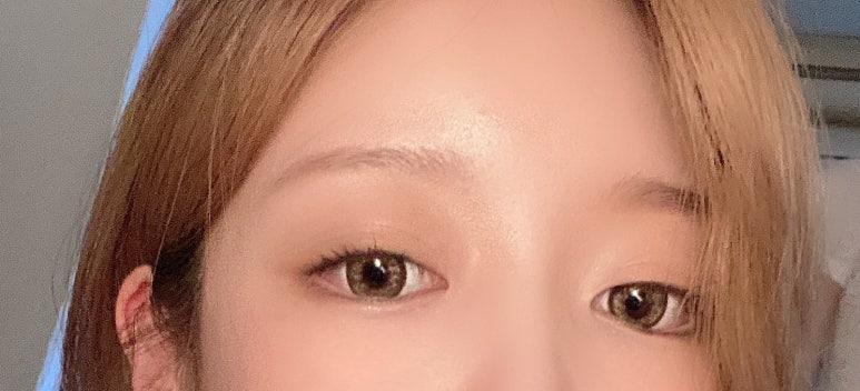 뒤트임후기 흉터 걱정 최소화하기 위해서 관련 이미지 3