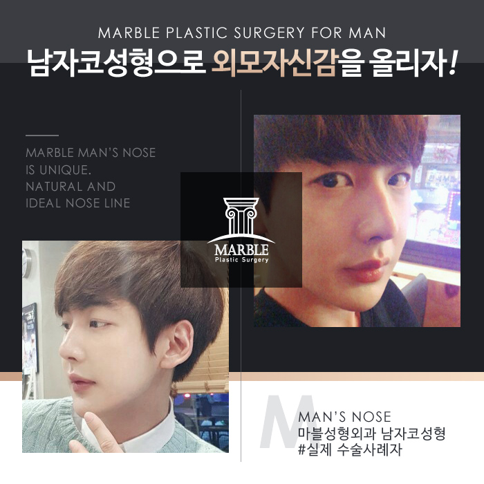 남자코수술전후 다양한 유형 살펴보기!마블성형외과의원 관련 이미지 10