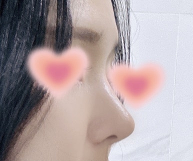 [강남역 성형외과 코수술 후기] 김준형 원장님 덕분에무보형물로 코끝교정 성공! 예쁜 직반 라인 얻었어요ㅎㅎ 관련 이미지 6
