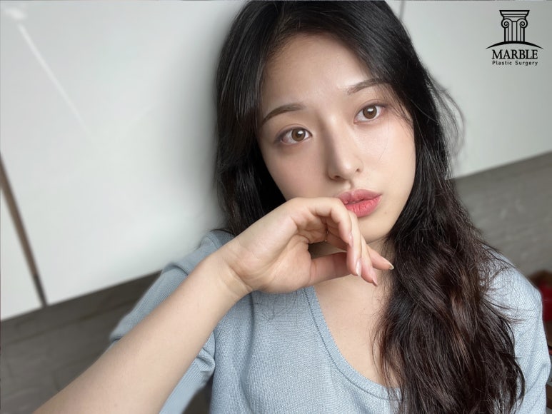 앞트임수술, 답답한 눈 탈출은 마블성형외과의원! 관련 이미지 1