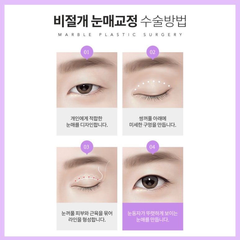 안검하수 처진눈 교정으로 또렷한 눈매를! 관련 이미지 7
