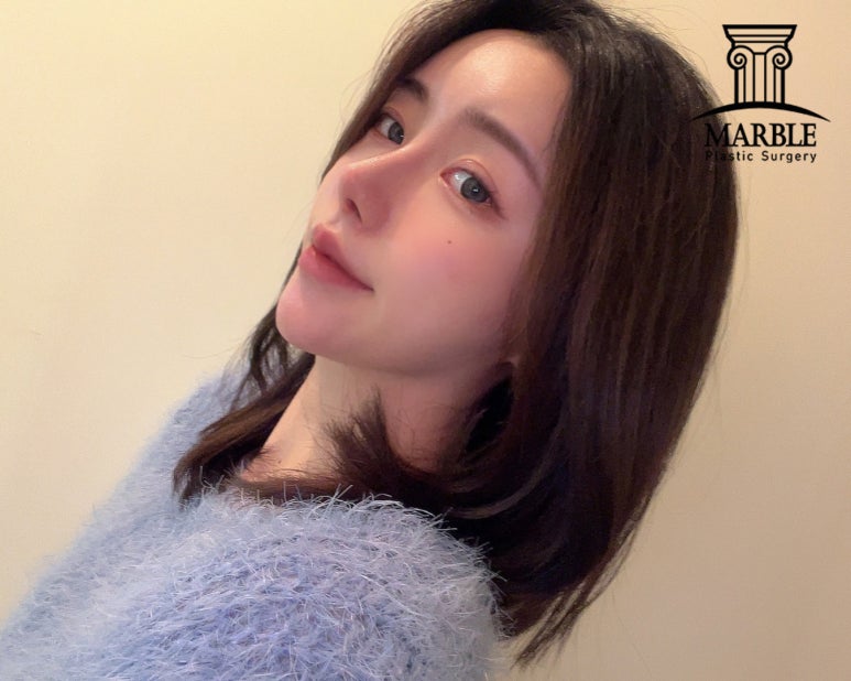 눈재수술, 반복되지 않으려면 마블성형외과의원에서! 관련 이미지 8