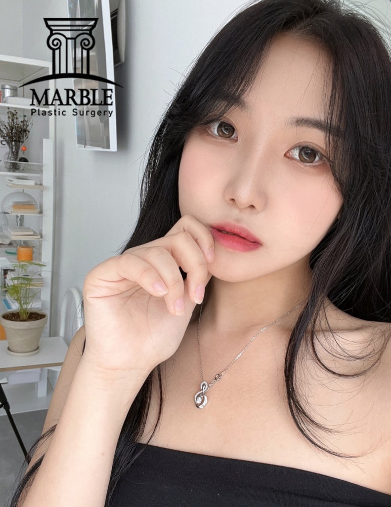 쌍꺼풀수술비용, 합리적인 변화는 마블성형외과의원! 관련 이미지 4