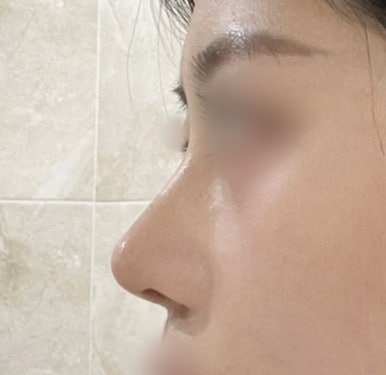 [마블성형외과 코수술 후기] 퍼진 복코에 매부리까지.. 인상 강해 보여서 거울 보기 싫었던 과거 탈출ㅠㅠ 관련 이미지 6