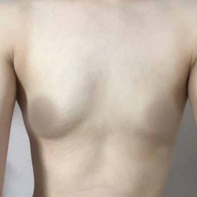 [Gangnam Plastic Surgery Breast Surgery Review] Worried About Asymmetrical Breasts... After Meeting Dr. Seo Il-beom, My Clothes Fit and Look So Much Better! image 4