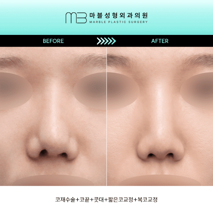 [Revision Rhinoplasty] 2 Months After Bulbous Nose Correction: The Standard Approach to Bulbous Nose and Short Nose Correction image 1