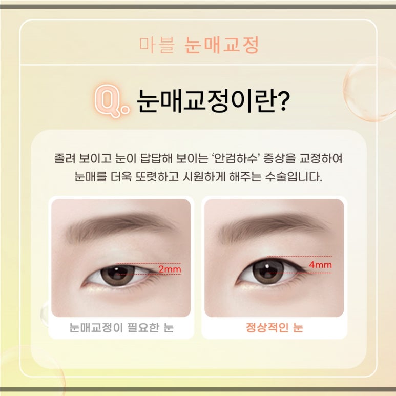 눈매교정 수술, 나도 필요한가? 관련 이미지 2