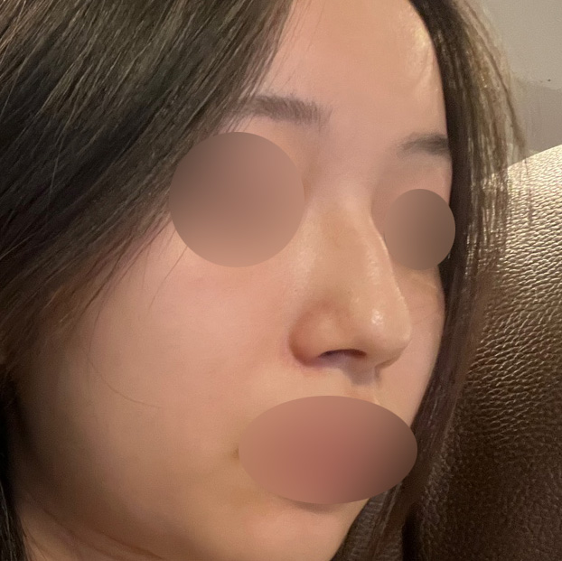 Hump Nose Surgery Is Not Simply a Procedure to Shave It Down. image 1