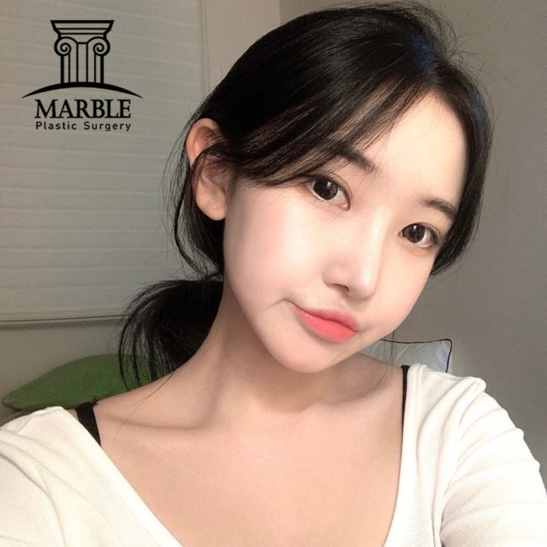 쌍꺼풀수술비용, 합리적인 변화는 마블성형외과의원! 관련 이미지 2