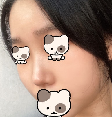 [Gangnam Station Plastic Surgery Hump Nose Surgery Review] I Escaped the Hump That Fillers Couldn’t Fix! It Looks Prettier with a Slim, Straight Line Haha image 3