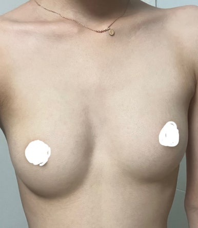 [Breast Surgery Review at a Gangnam Plastic Surgery Clinic] 70A Was So Small That My Uneven Breasts Stressed Me Out... I Got My Dream Boobs with Mentor Extra! Haha image 4