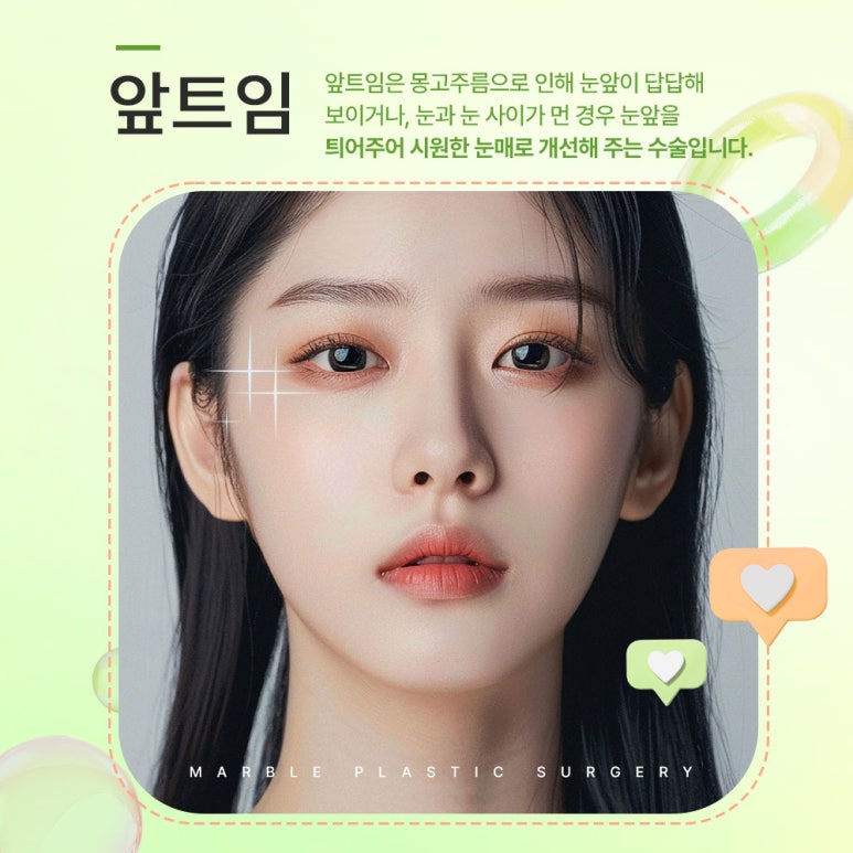 트임수술은 마블성형외과의원 관련 이미지 1